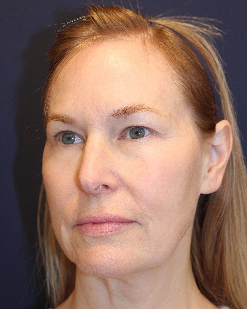 Facelift Gallery Before & After