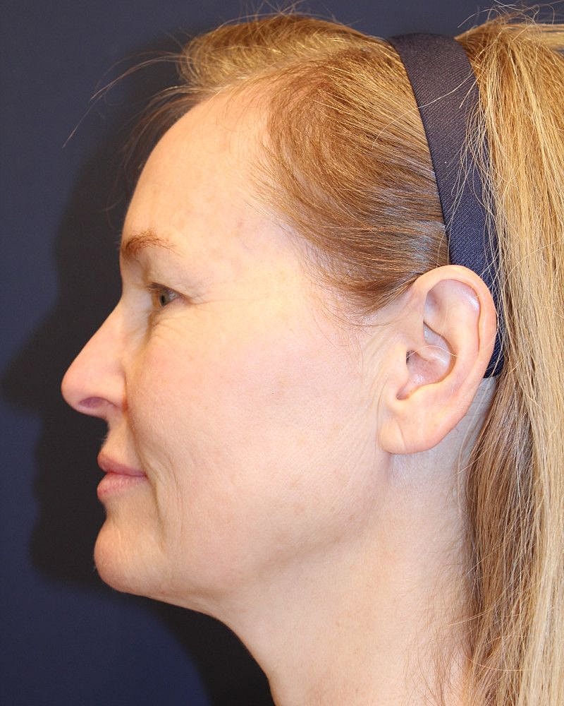 Facelift Gallery Before & After