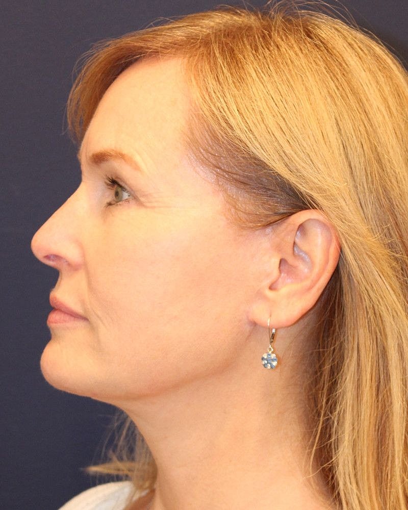 Facelift Gallery Before & After