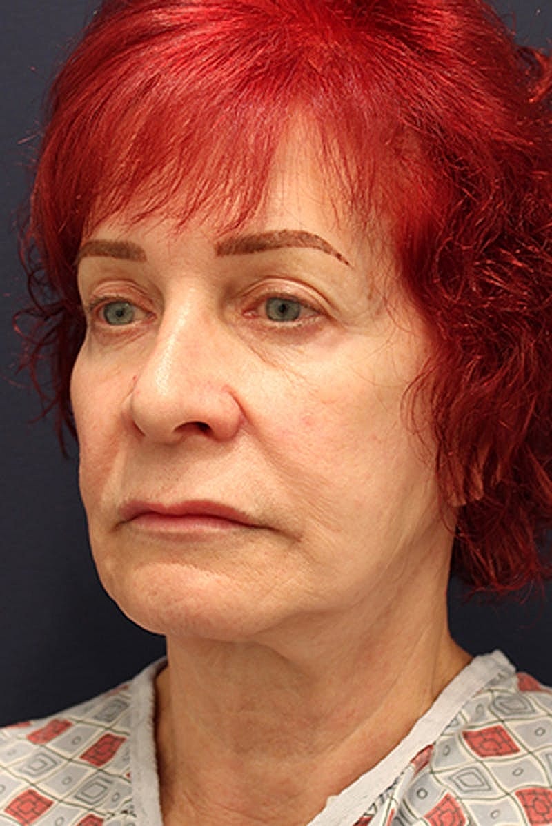 Rhinoplasty Before & After