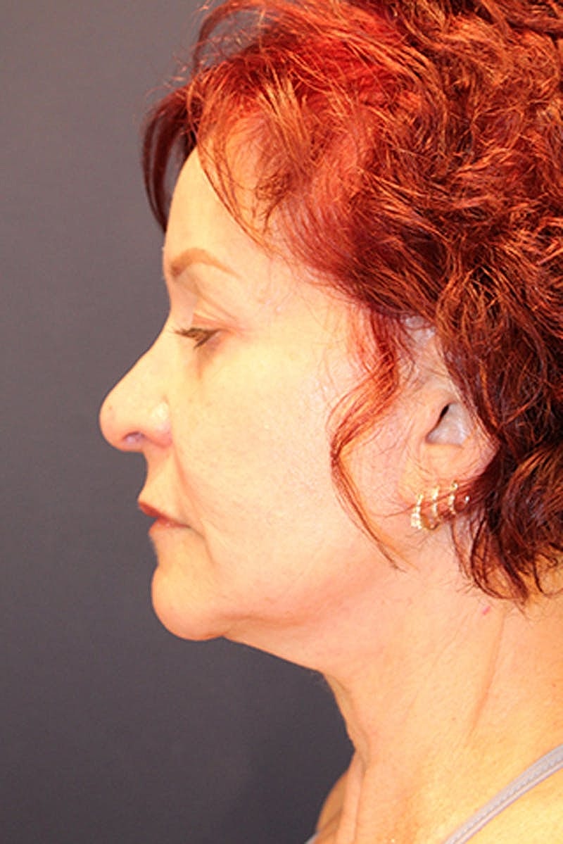 Rhinoplasty Before & After