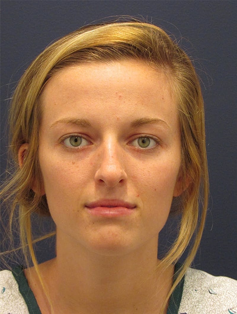 Rhinoplasty Before & After