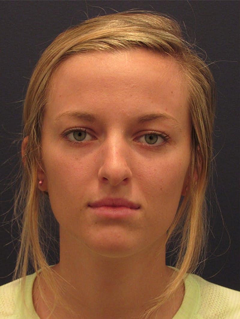 Rhinoplasty Before & After