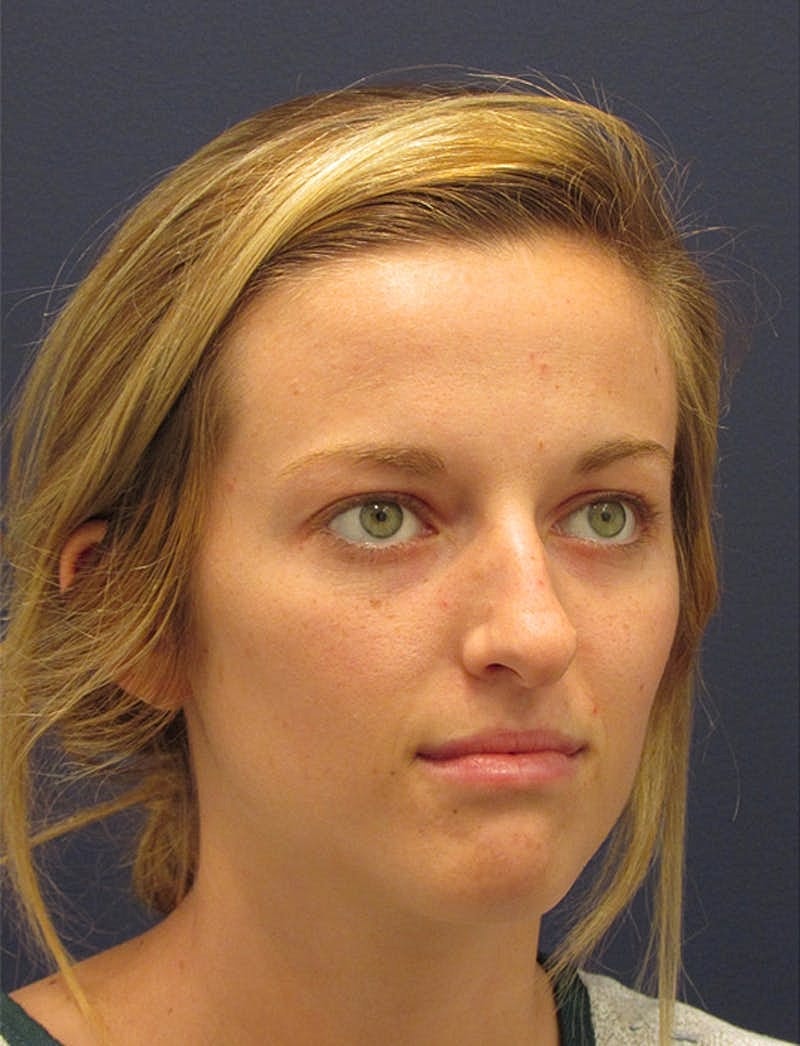 Rhinoplasty Before & After