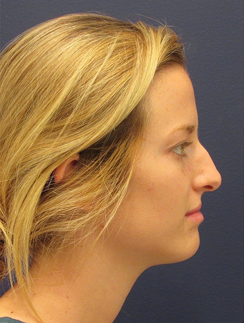 Rhinoplasty Before & After