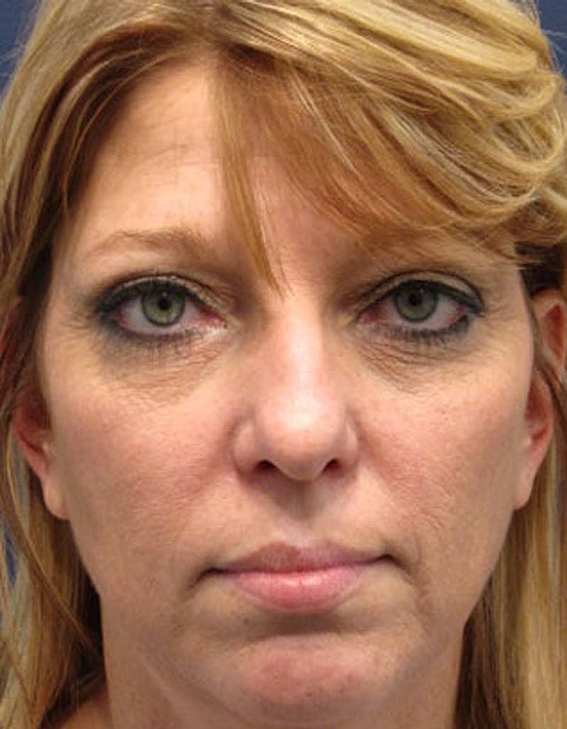 Rhinoplasty Before & After