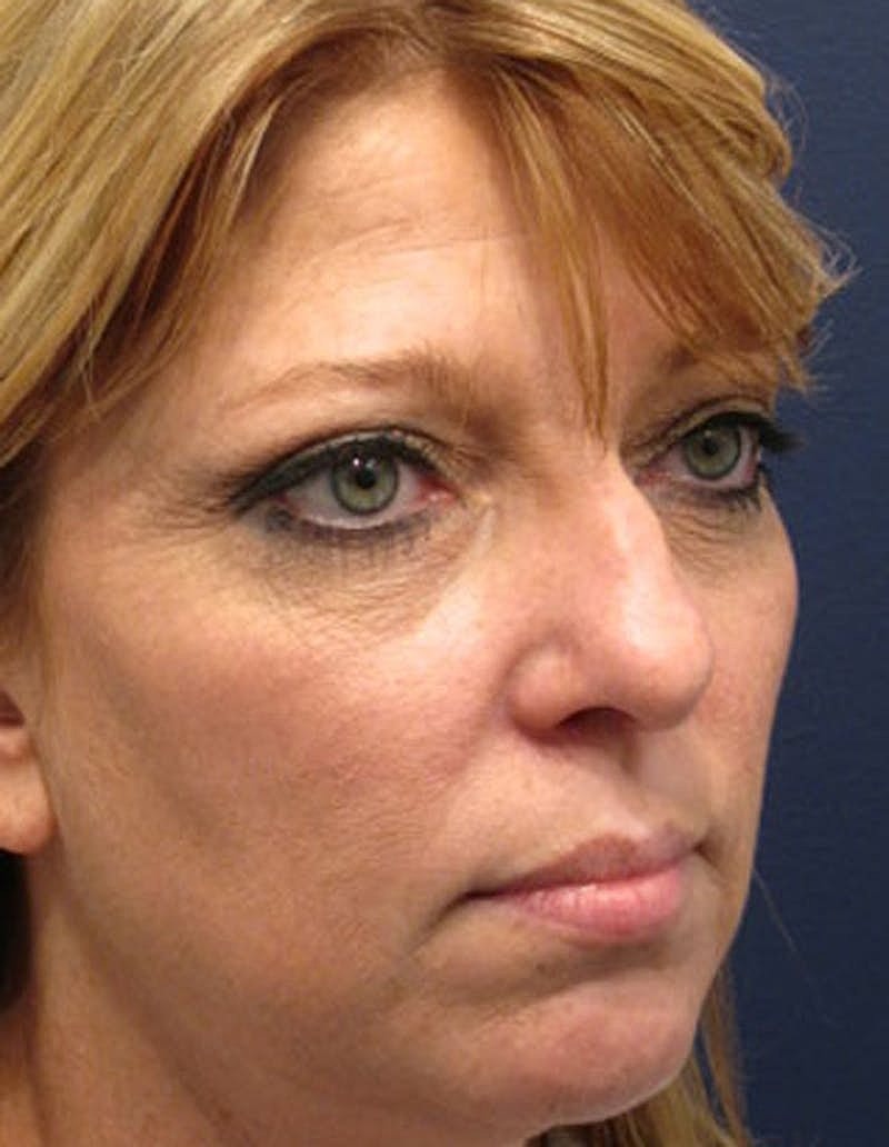 Rhinoplasty Before & After