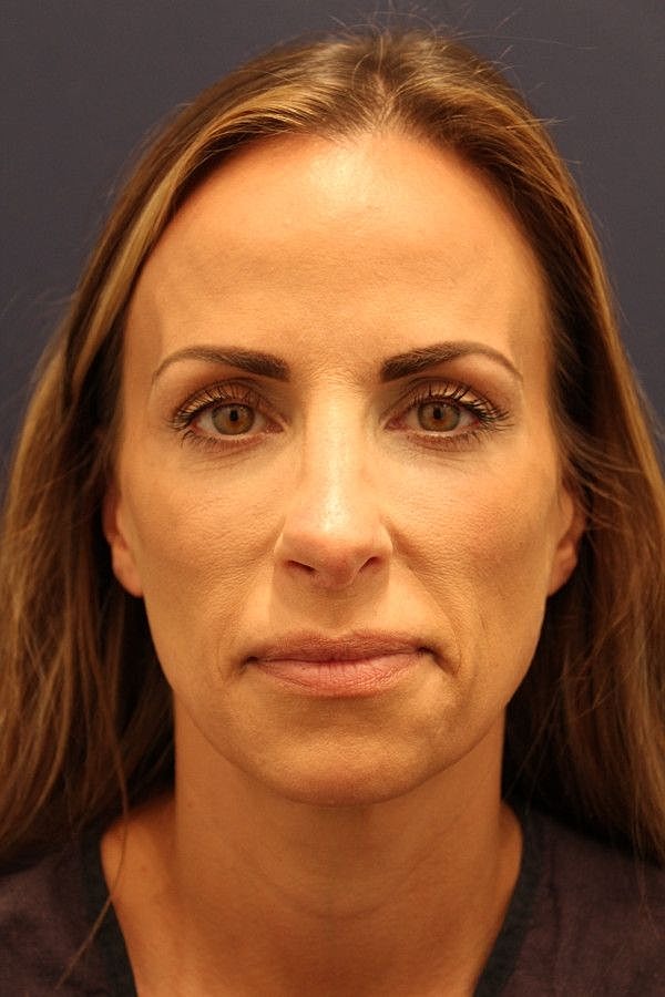 Rhinoplasty Gallery Before & After