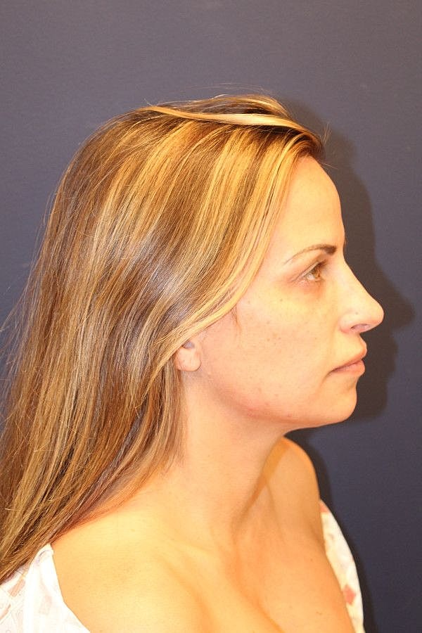 Rhinoplasty Gallery Before & After