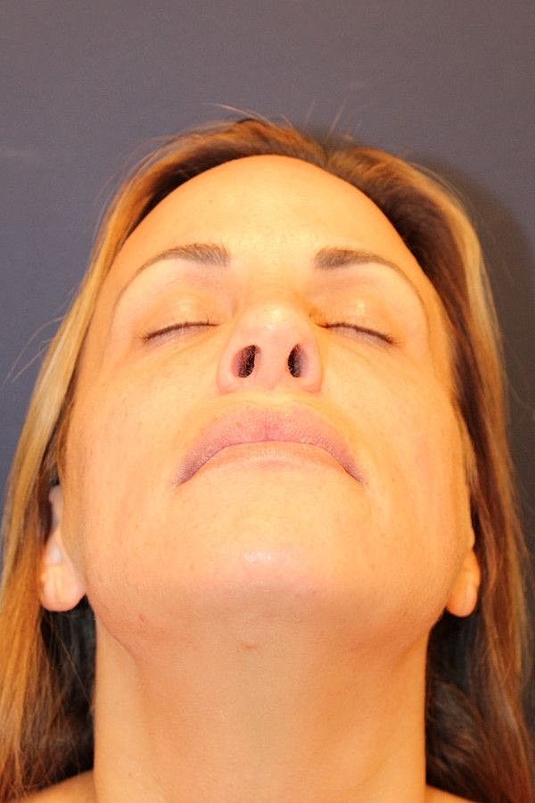 Rhinoplasty Gallery Before & After
