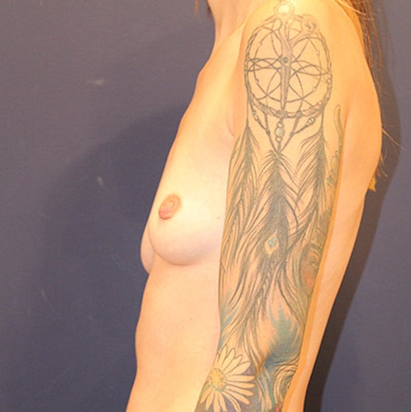 Breast Augmentation Before & After