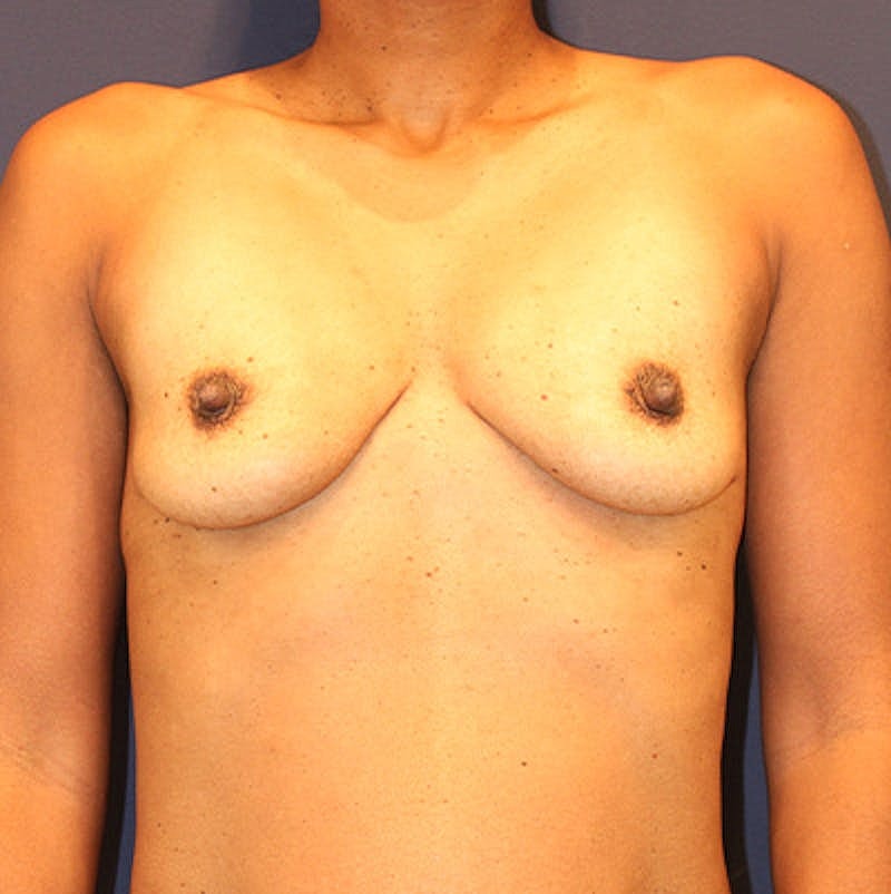 Breast Augmentation Before & After