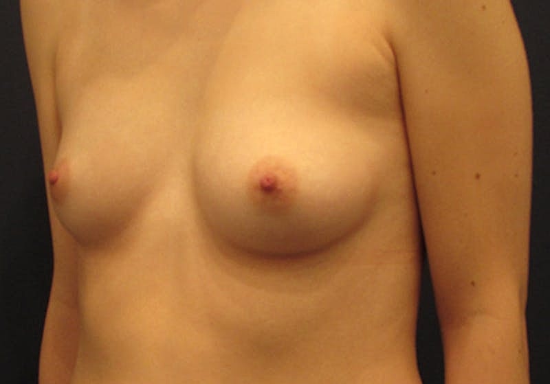 Breast Augmentation Before & After