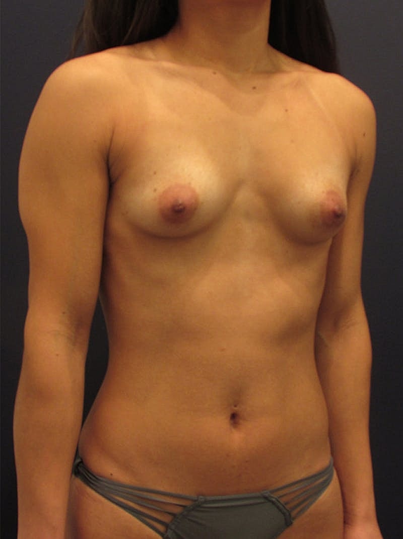 Breast Augmentation Before & After