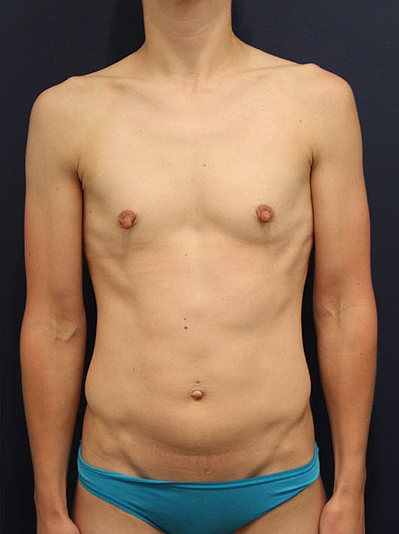 Breast Augmentation Before & After
