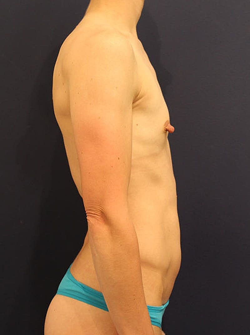 Breast Augmentation Before & After