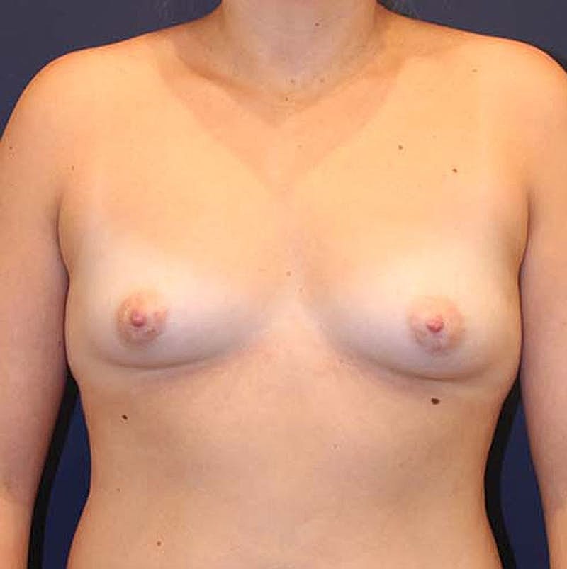 Breast Augmentation Before & After