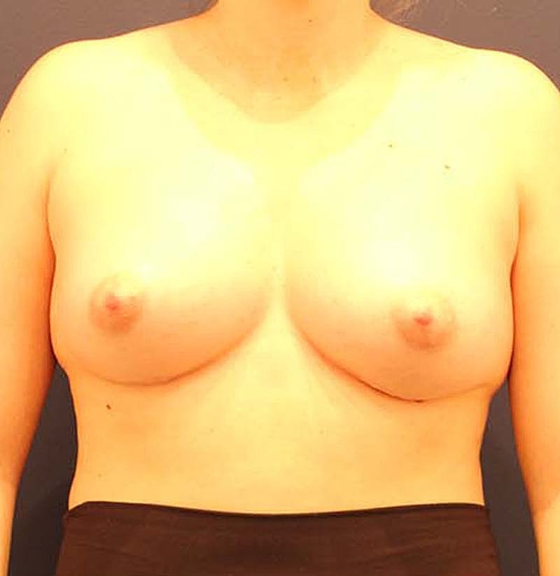 Breast Augmentation Before & After