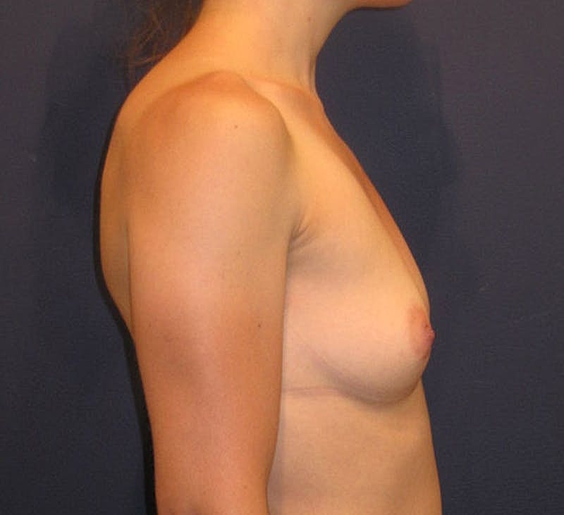 Breast Augmentation Before & After