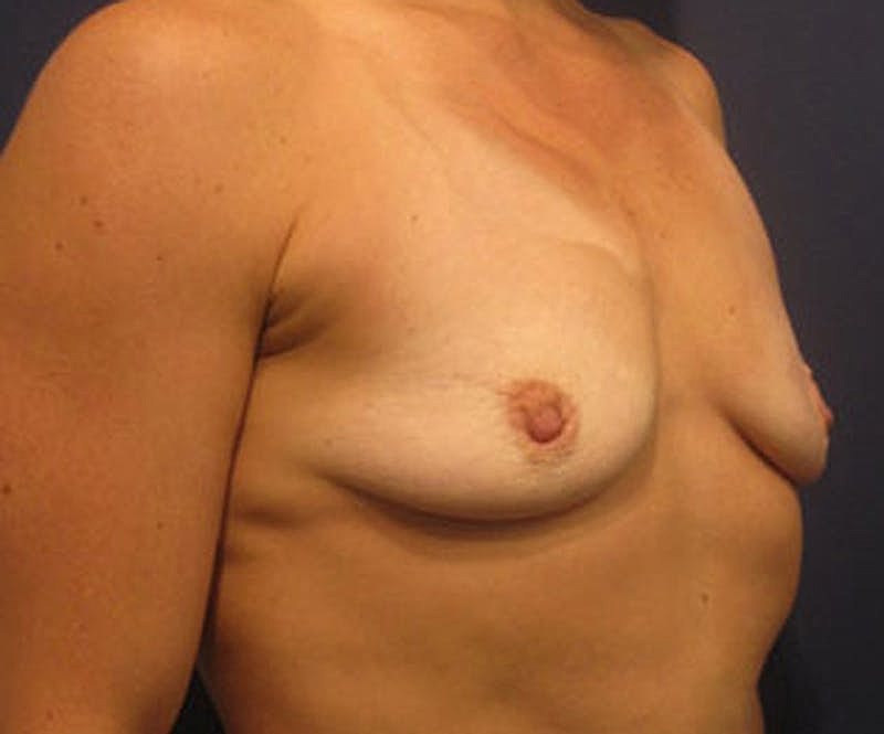 Breast Augmentation Before & After