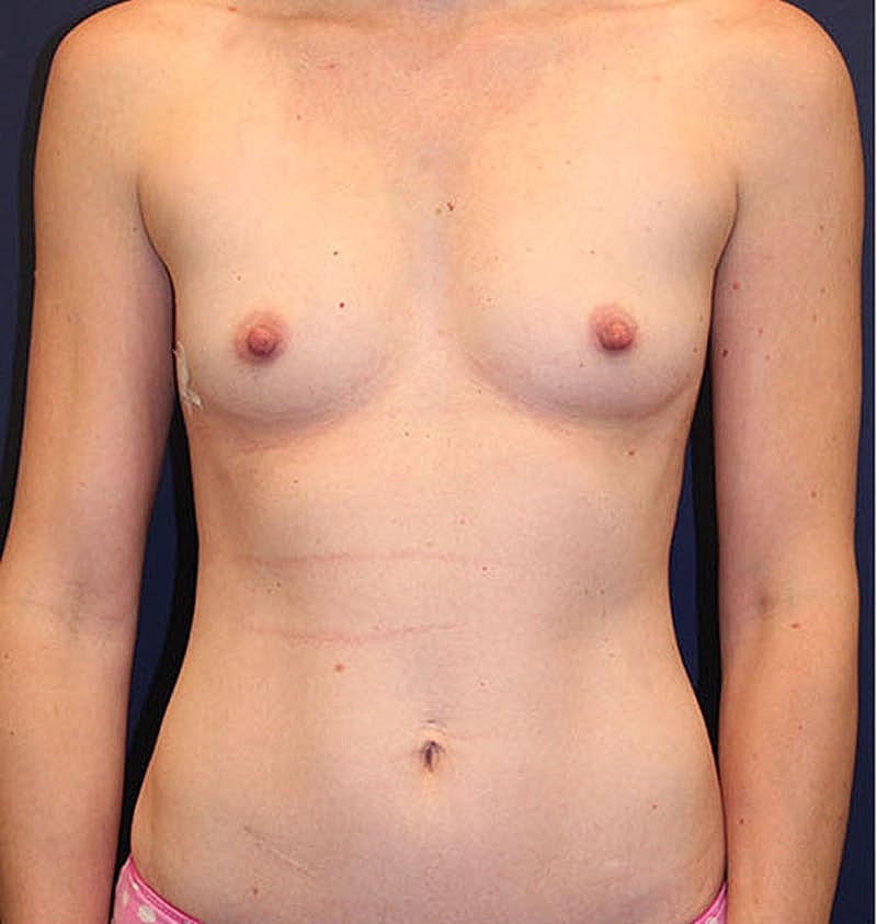 Breast Augmentation Before & After