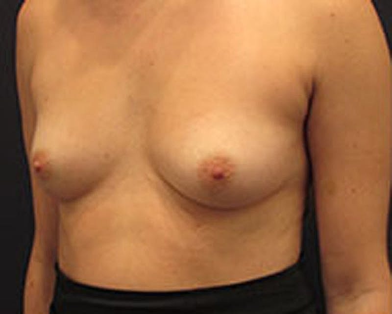 Breast Augmentation Before & After