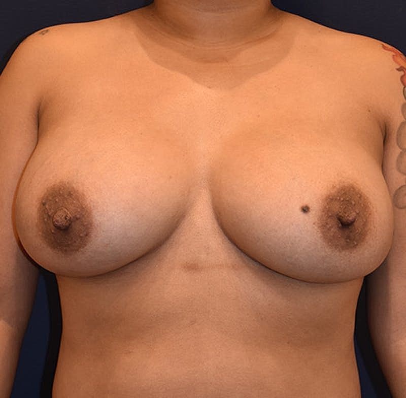 Breast Augmentation Before & After