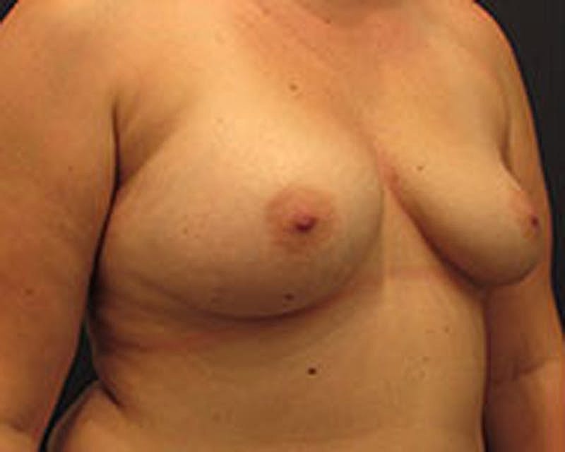 Breast Augmentation Before & After