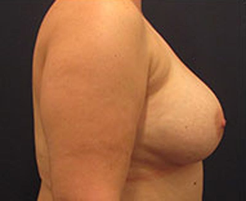 Breast Augmentation Before & After