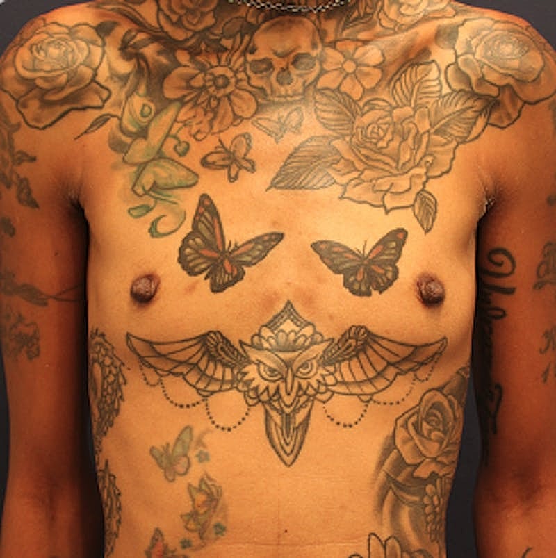 Breast Augmentation Before & After