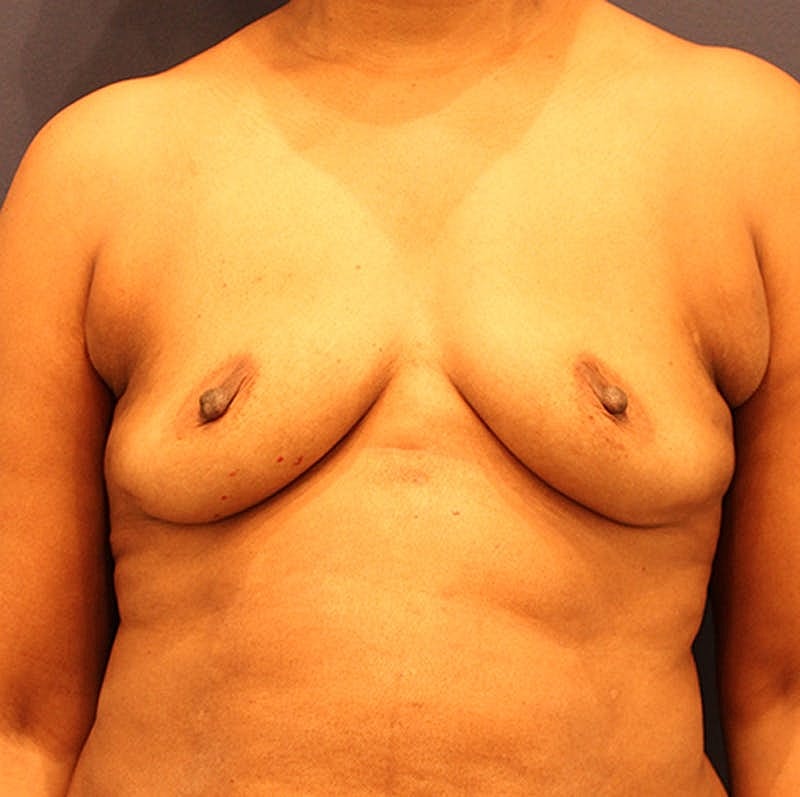 Breast Augmentation Before & After