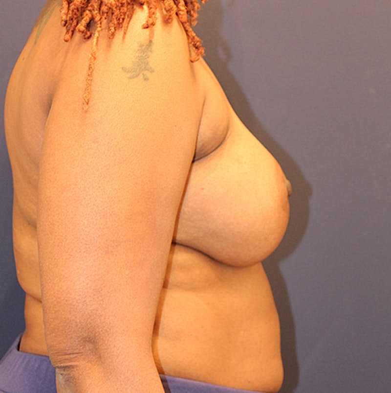 Breast Augmentation Before & After
