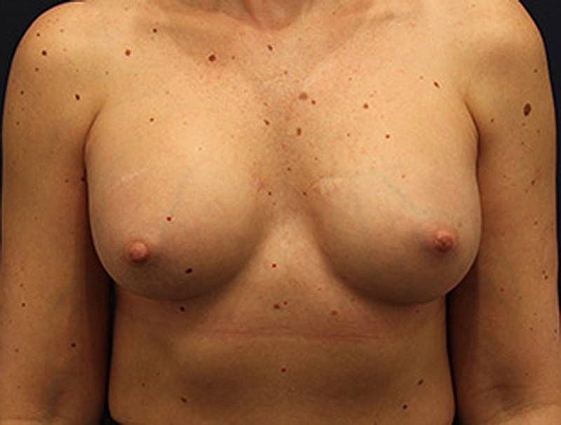 Breast Augmentation Before & After