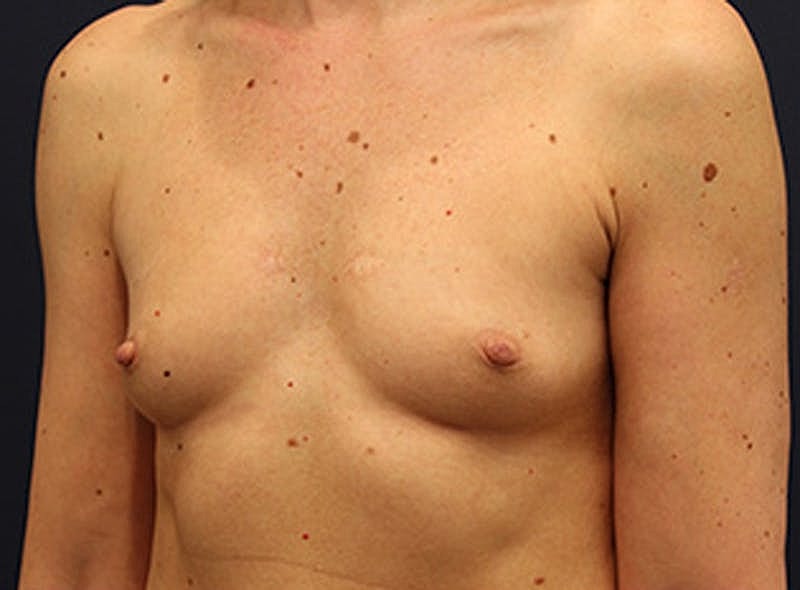 Breast Augmentation Before & After