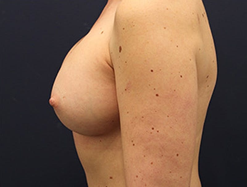 Breast Augmentation Before & After