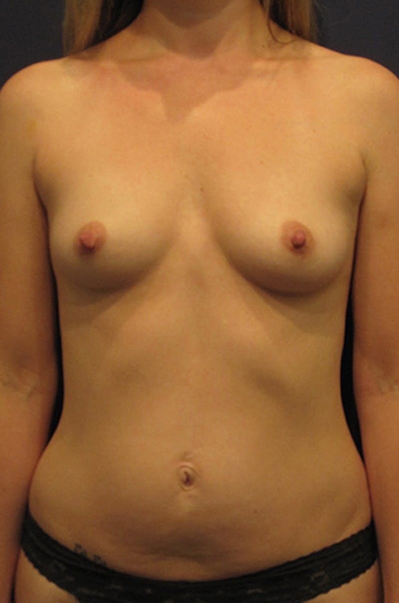 Breast Augmentation Before & After