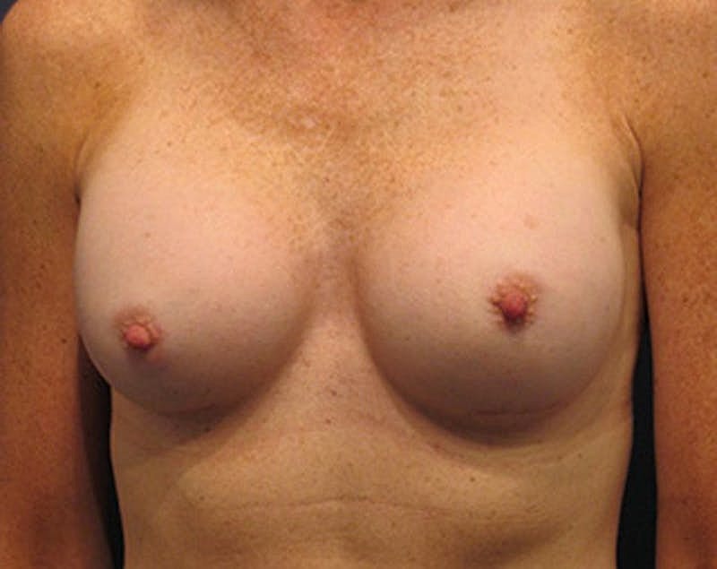 Breast Augmentation Before & After