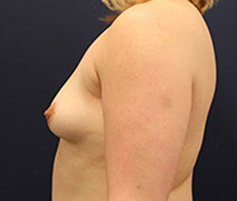 Breast Augmentation Before & After