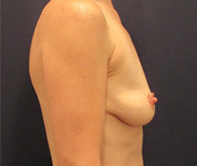 Breast Augmentation Before & After