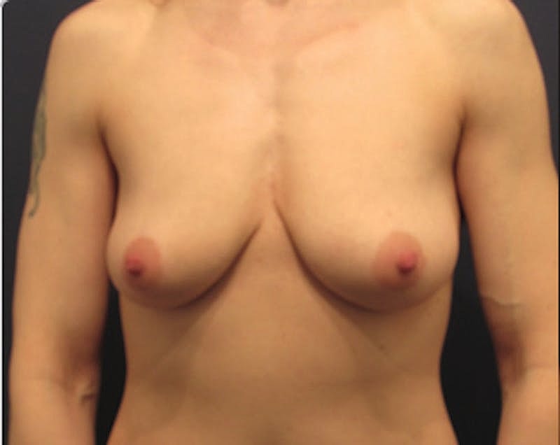 Breast Augmentation Before & After