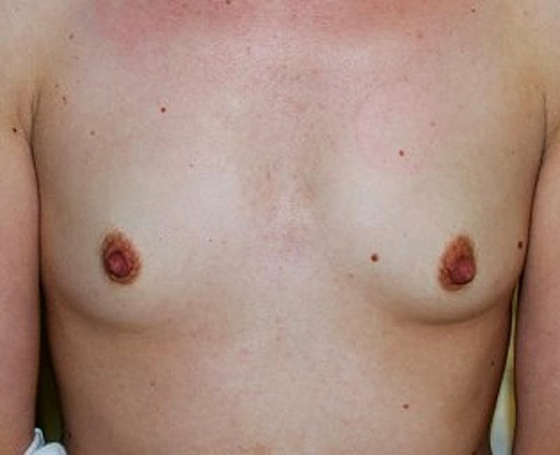 Breast Augmentation Before & After