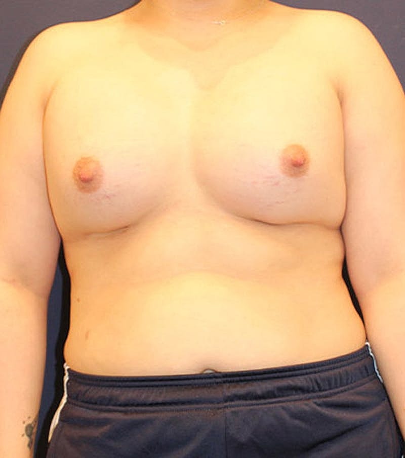 Breast Augmentation Before & After