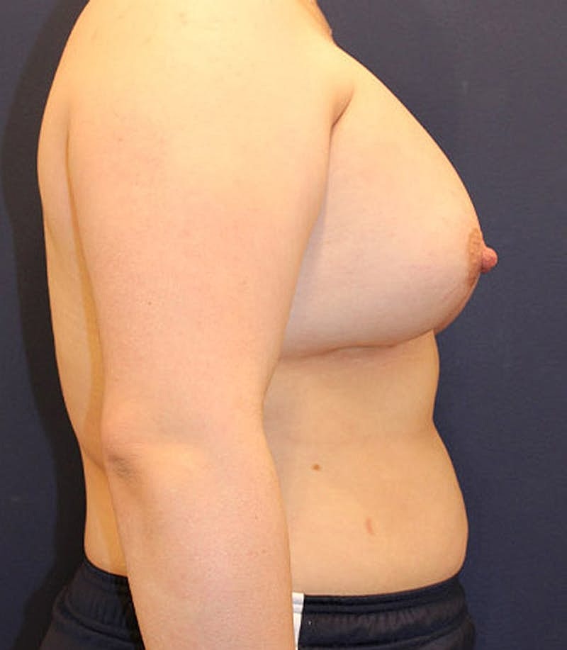 Breast Augmentation Before & After