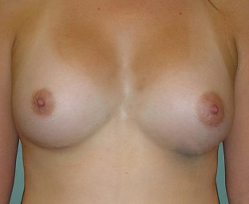 Breast Augmentation Before & After