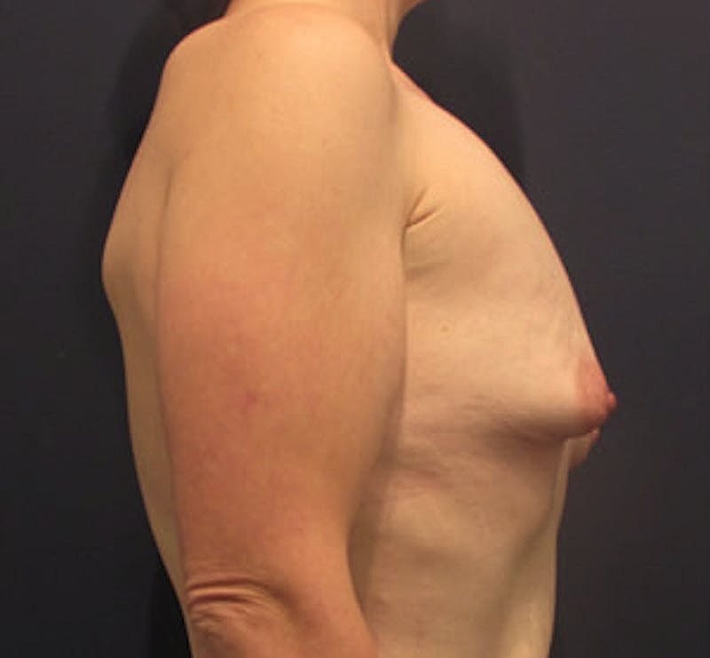 Breast Augmentation Before & After