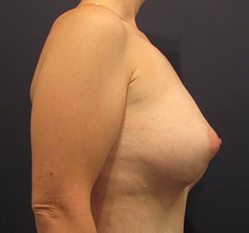 Breast Augmentation Before & After