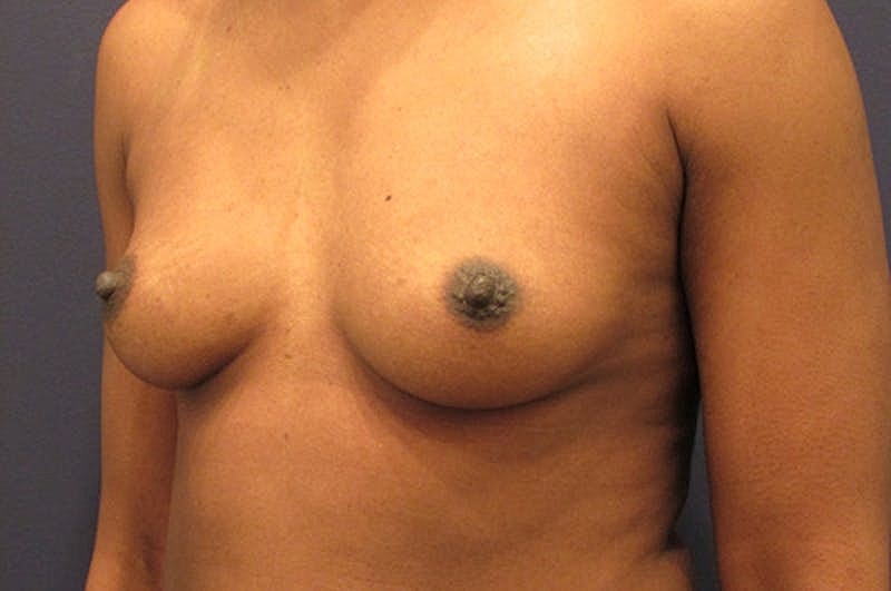 Breast Augmentation Before & After