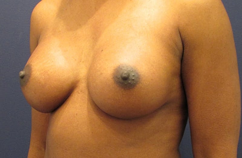 Breast Augmentation Before & After