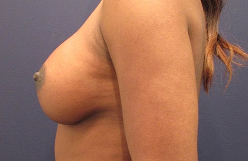 Breast Augmentation Before & After
