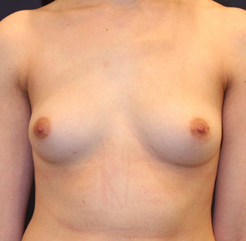 Breast Augmentation Before & After